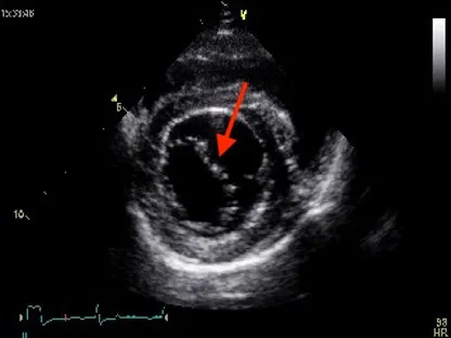 Echocardiogram highlighting the mitral valve